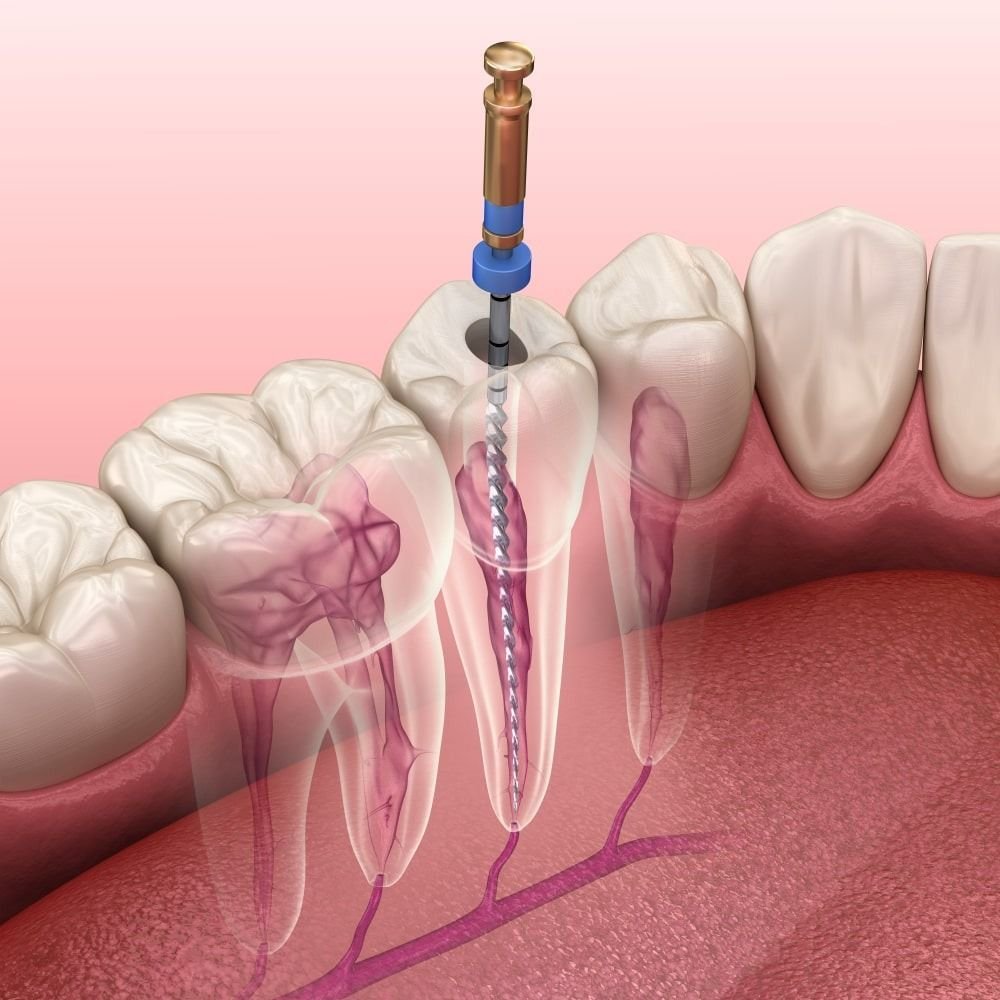 Root canal and restorative